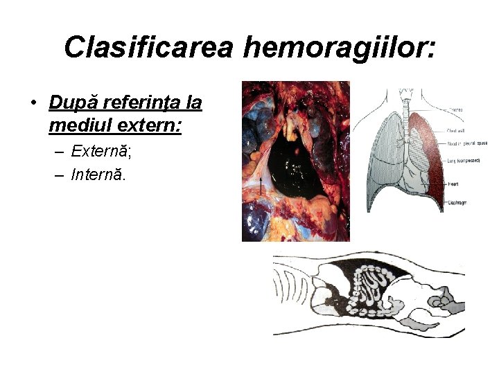 Clasificarea hemoragiilor: • După referinţa la mediul extern: – Externă; – Internă. 