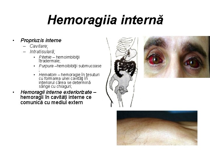 Hemoragiia internă • Propriuzis interne – Cavitare; – Intratisulară; • Pitehie – hemoimbibiţii îtradermale;