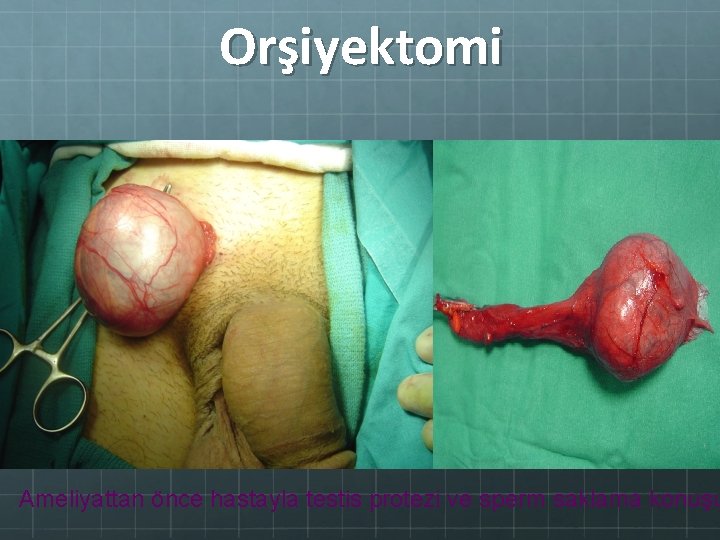 Orşiyektomi Ameliyattan önce hastayla testis protezi ve sperm saklama konuşu 