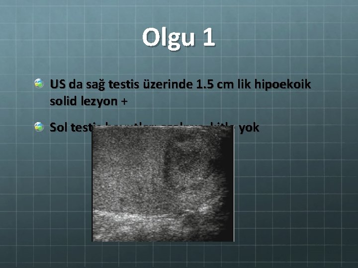 Olgu 1 US da sağ testis üzerinde 1. 5 cm lik hipoekoik solid lezyon