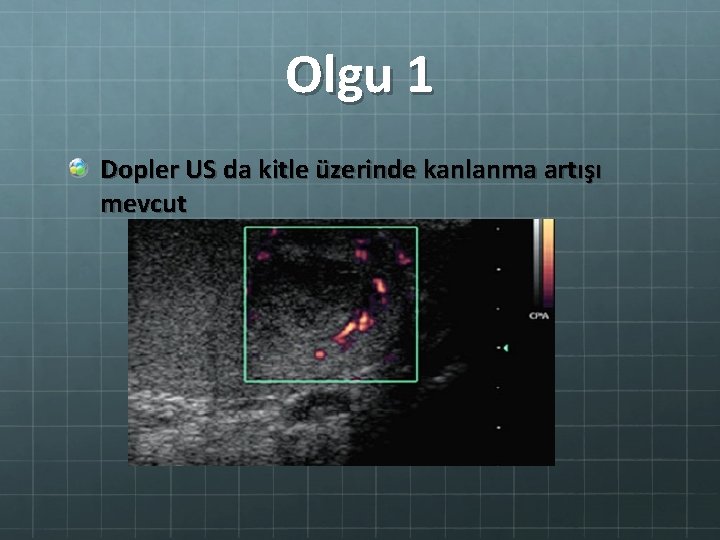 Olgu 1 Dopler US da kitle üzerinde kanlanma artışı mevcut 