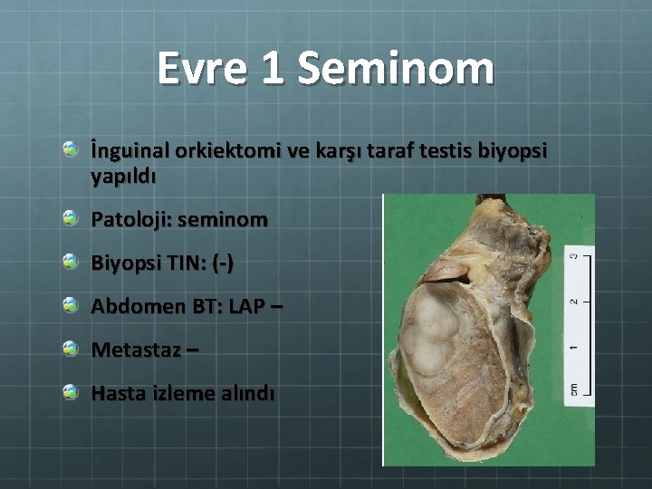 Evre 1 Seminom İnguinal orkiektomi ve karşı taraf testis biyopsi yapıldı Patoloji: seminom Biyopsi