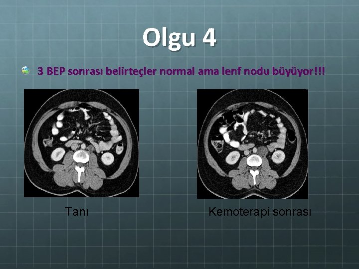 Olgu 4 3 BEP sonrası belirteçler normal ama lenf nodu büyüyor!!! Tanı Kemoterapi sonrası