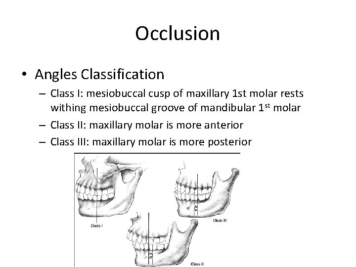 Occlusion • Angles Classification – Class I: mesiobuccal cusp of maxillary 1 st molar