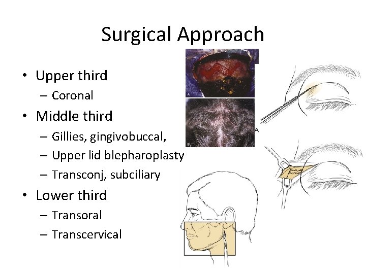 Surgical Approach • Upper third – Coronal • Middle third – Gillies, gingivobuccal, –