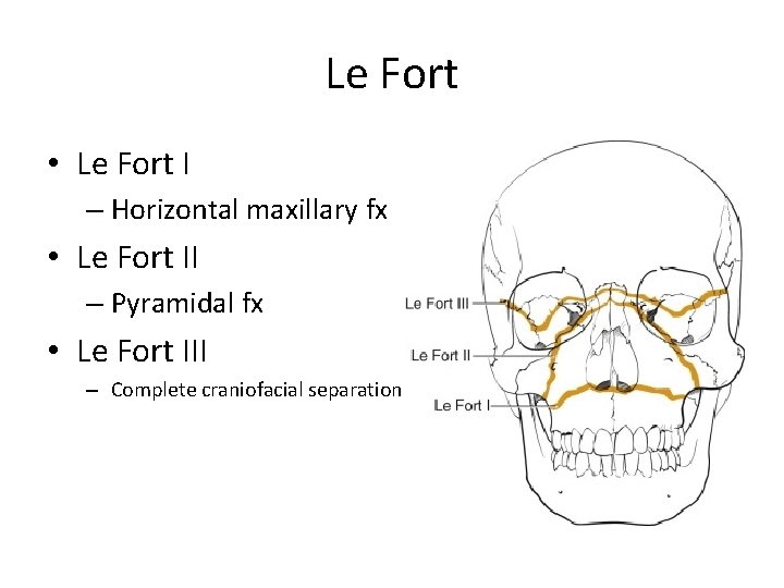 Le Fort • Le Fort I – Horizontal maxillary fx • Le Fort II