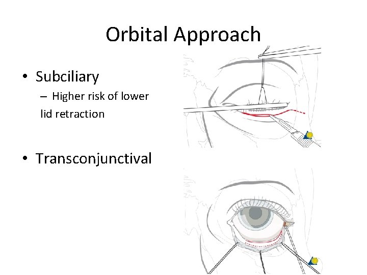 Orbital Approach • Subciliary – Higher risk of lower lid retraction • Transconjunctival 