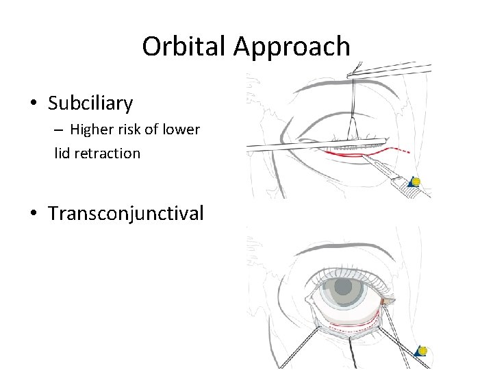 Orbital Approach • Subciliary – Higher risk of lower lid retraction • Transconjunctival 