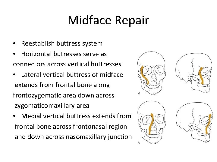 Midface Repair • Reestablish buttress system • Horizontal butresses serve as connectors across vertical