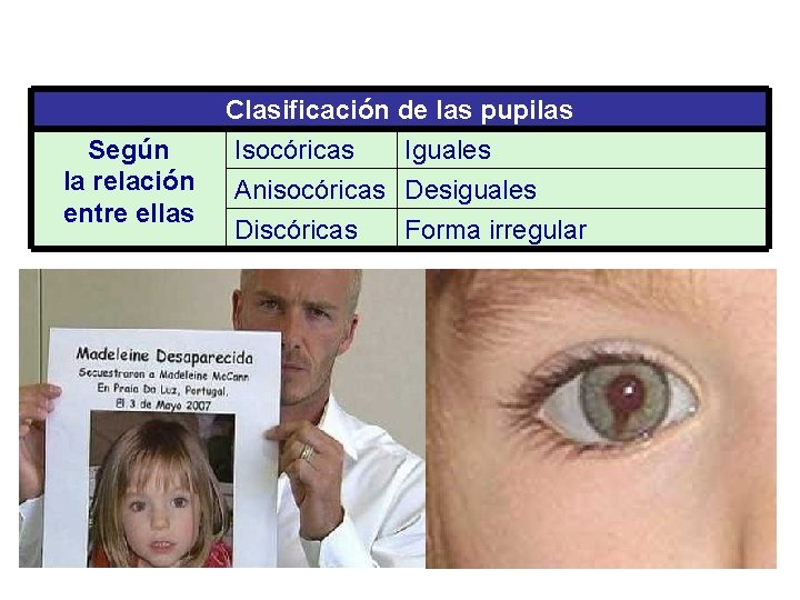 Clasificación de las pupilas Según Isocóricas Iguales la relación Anisocóricas Desiguales entre ellas Discóricas