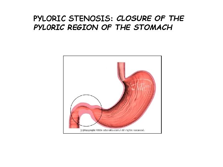 PYLORIC STENOSIS: CLOSURE OF THE PYL 0 RIC REGION OF THE STOMACH 