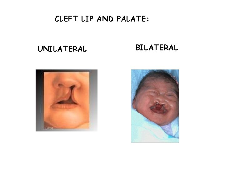 CLEFT LIP AND PALATE: UNILATERAL BILATERAL 