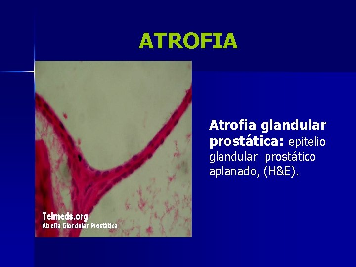 ATROFIA Atrofia glandular prostática: epitelio glandular prostático aplanado, (H&E). 