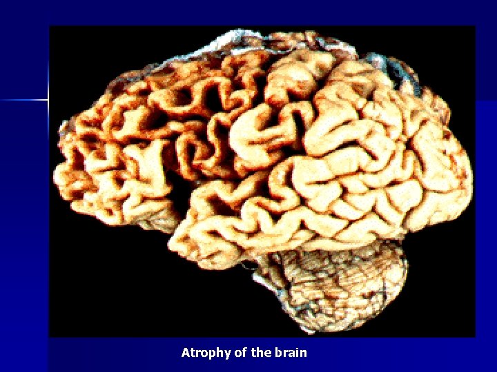 Atrophy of the brain 