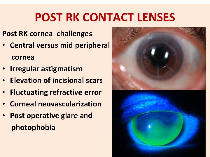 POST RK CONTACT LENSES Post RK cornea challenges • Central versus mid peripheral cornea