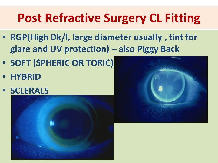 Post Refractive Surgery CL Fitting • RGP(High Dk/l, large diameter usually , tint for