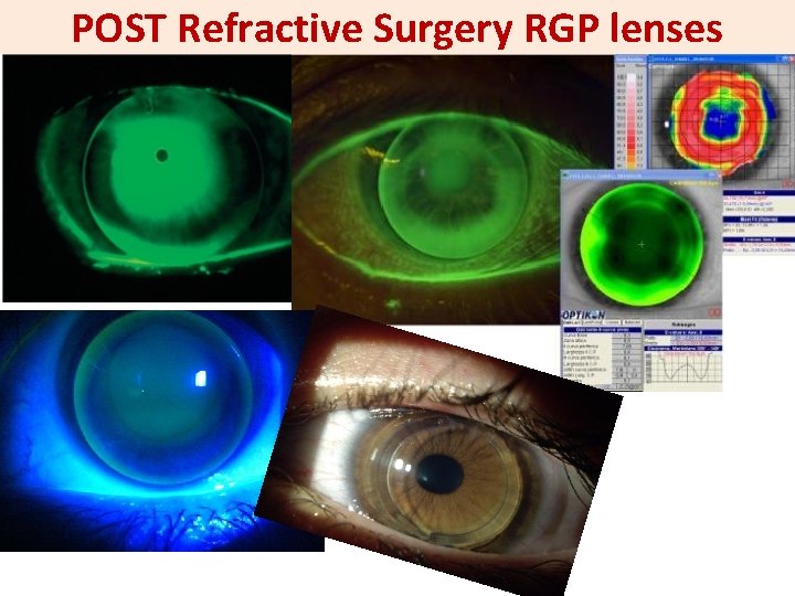 POST Refractive Surgery RGP lenses 