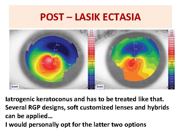 POST – LASIK ECTASIA Iatrogenic keratoconus and has to be treated like that. Several