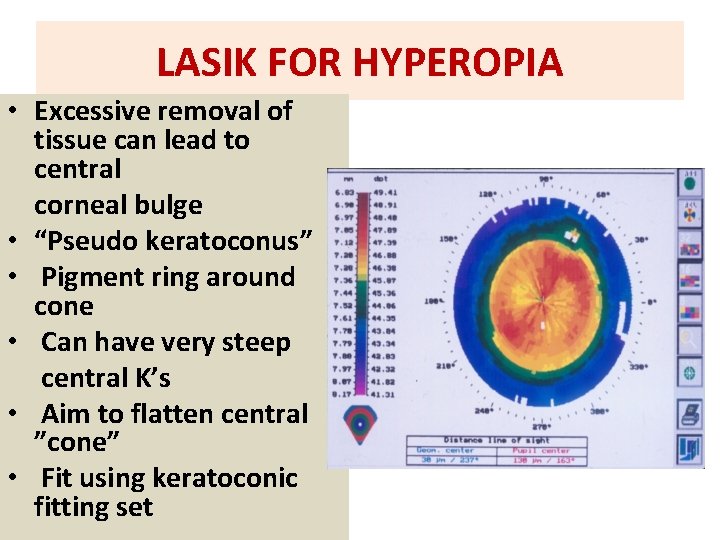 LASIK FOR HYPEROPIA • Excessive removal of tissue can lead to central corneal bulge