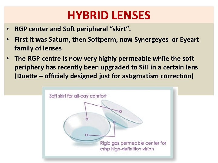 HYBRID LENSES • RGP center and Soft peripheral “skirt”. • First it was Saturn,