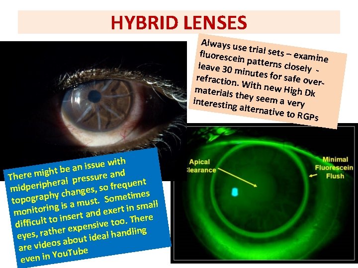 HYBRID LENSES Always u se trial se ts – exam fluoresce in pattern s