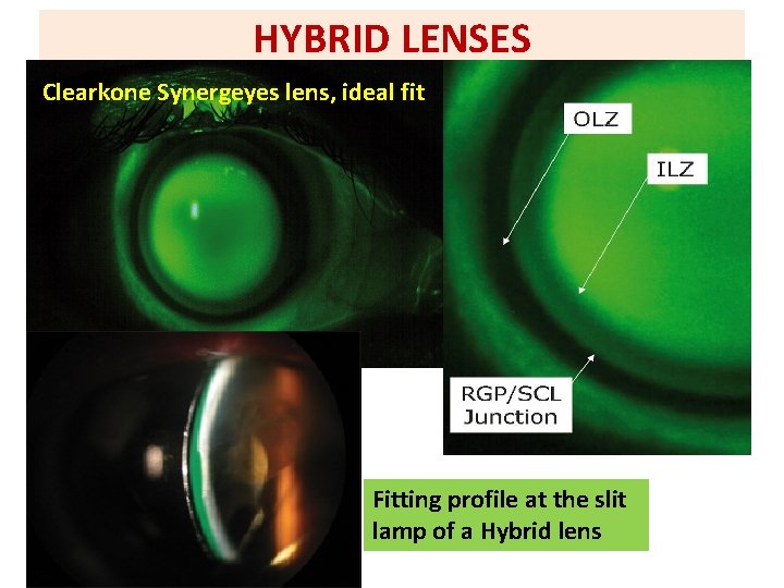 HYBRID LENSES Clearkone Synergeyes lens, ideal fit Fitting profile at the slit lamp of