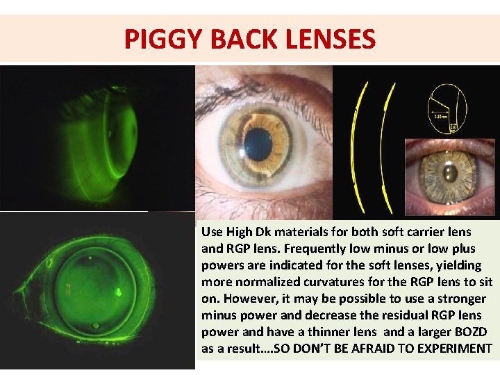 PIGGY BACK LENSES Use High Dk materials for both soft carrier lens and RGP