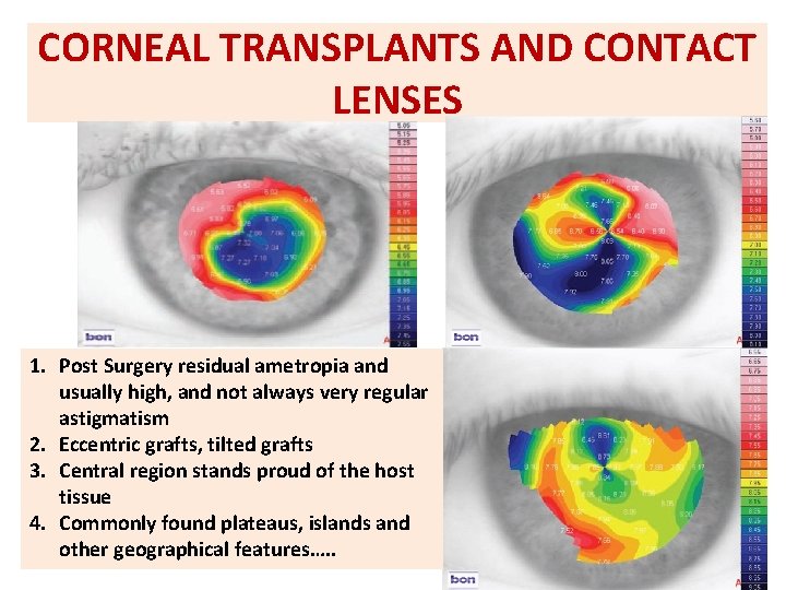 CORNEAL TRANSPLANTS AND CONTACT LENSES 1. Post Surgery residual ametropia and usually high, and