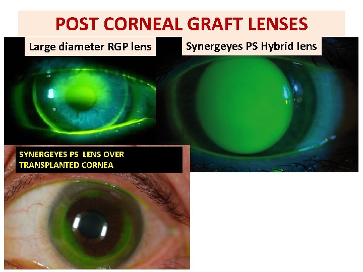 POST CORNEAL GRAFT LENSES Large diameter RGP lens SYNERGEYES PS LENS OVER TRANSPLANTED CORNEA