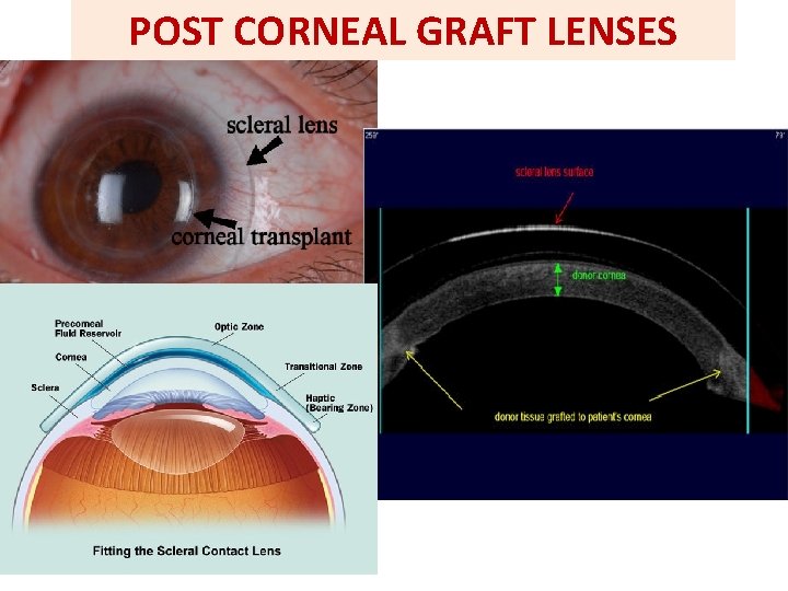 POST CORNEAL GRAFT LENSES 