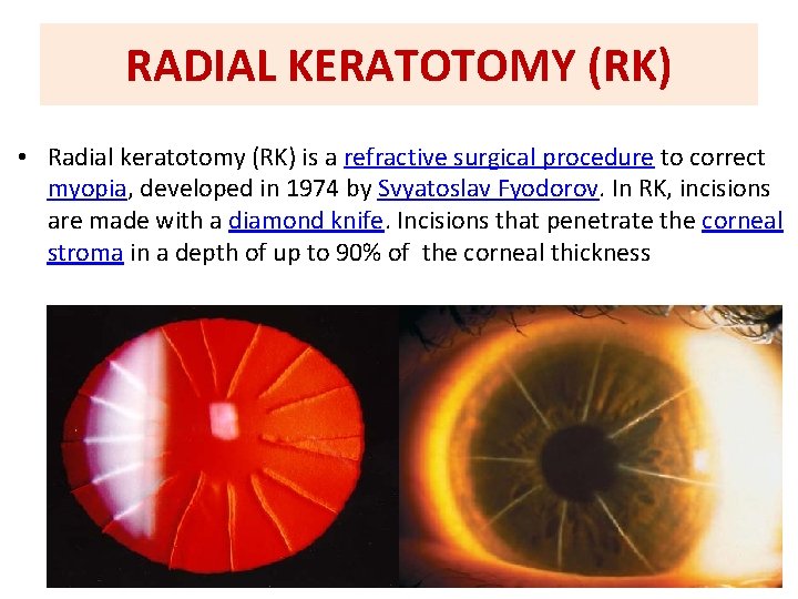 RADIAL KERATOTOMY (RK) • Radial keratotomy (RK) is a refractive surgical procedure to correct