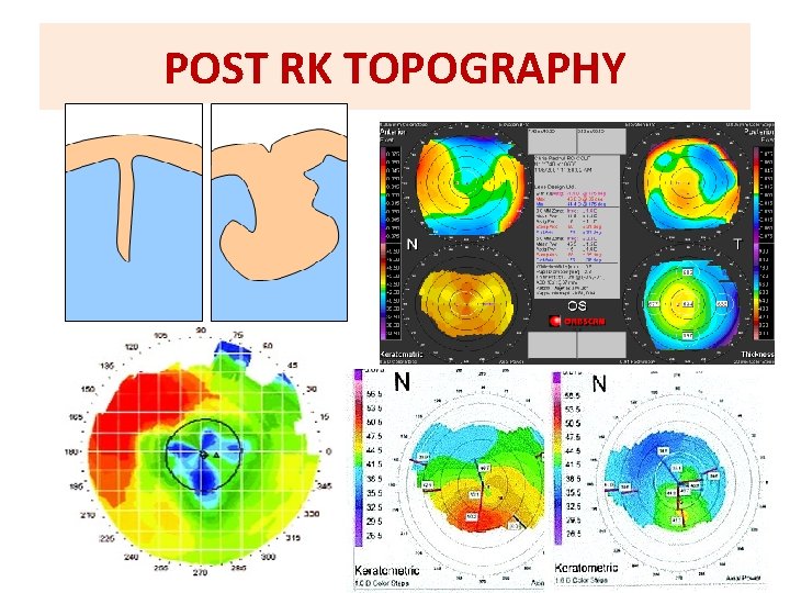 POST RK TOPOGRAPHY 