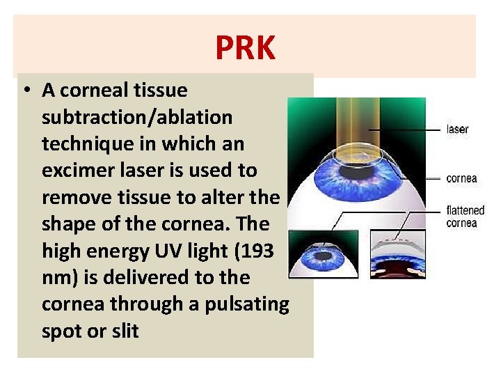 PRK • A corneal tissue subtraction/ablation technique in which an excimer laser is used