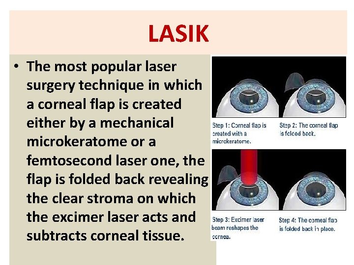 LASIK • The most popular laser surgery technique in which a corneal flap is