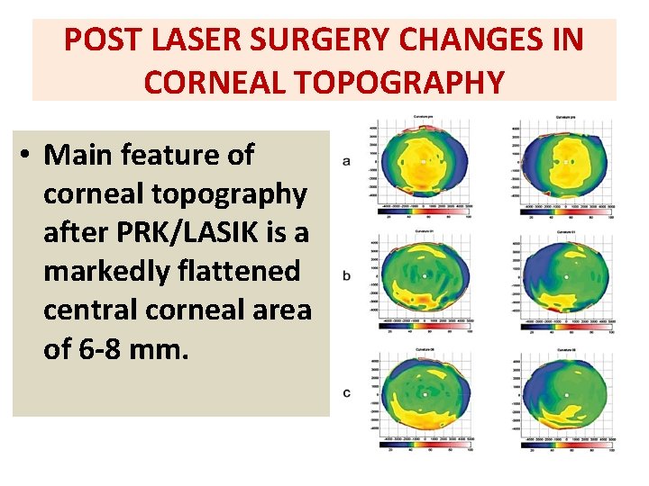 POST LASER SURGERY CHANGES IN CORNEAL TOPOGRAPHY • Main feature of corneal topography after