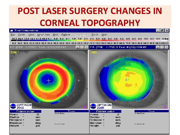 POST LASER SURGERY CHANGES IN CORNEAL TOPOGRAPHY 