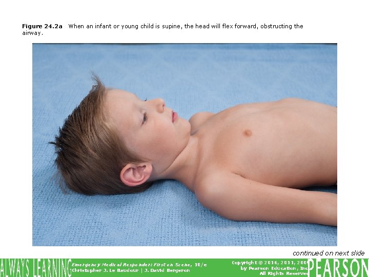Figure 24. 2 a airway. When an infant or young child is supine, the