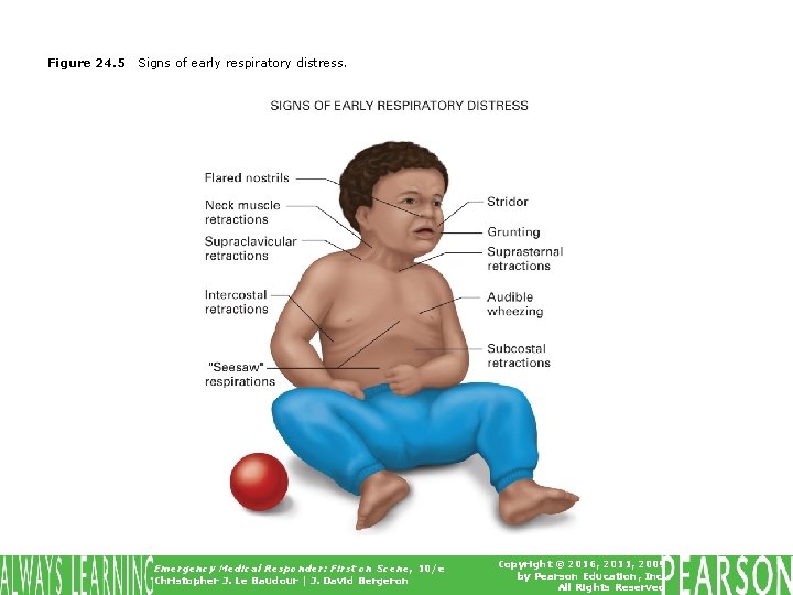 Figure 24. 5 Signs of early respiratory distress. Emergency Medical Responder: First on Scene,