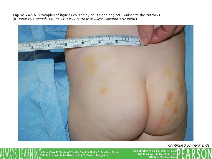 Figure 24. 9 a Examples of injuries caused by abuse and neglect. Bruises to