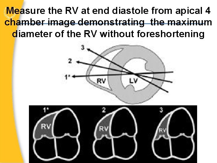 Measure the RV at end diastole from apical 4 chamber image demonstrating the maximum