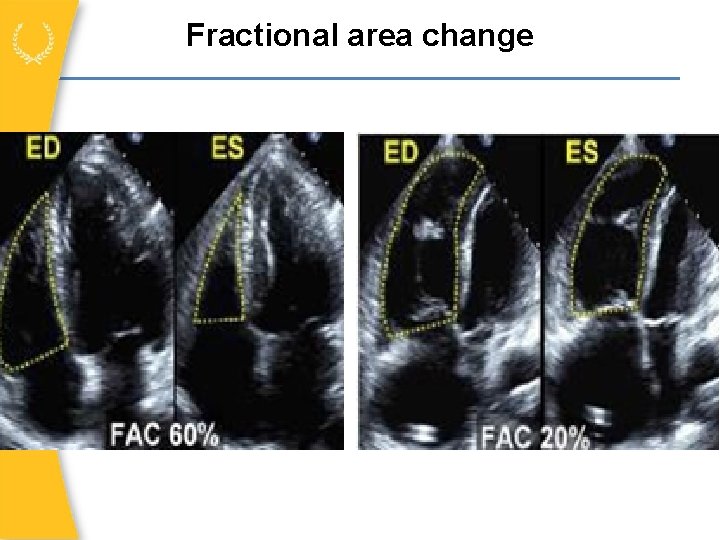 Fractional area change 