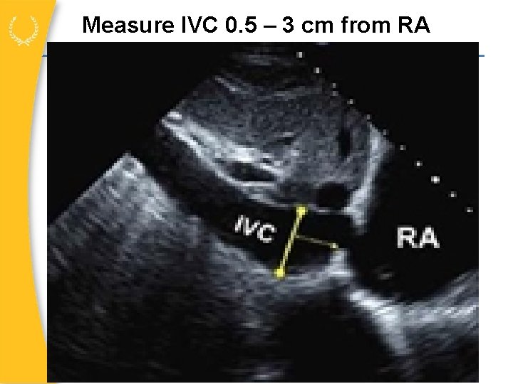 Measure IVC 0. 5 – 3 cm from RA 
