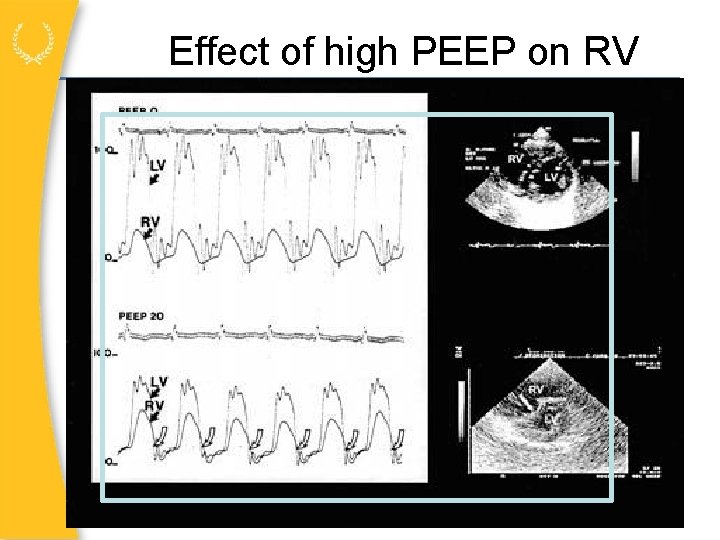 Effect of high PEEP on RV 