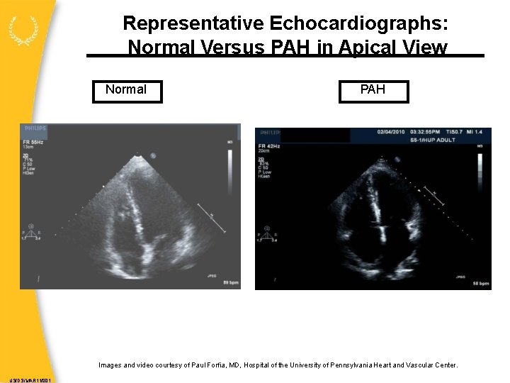 Representative Echocardiographs: Normal Versus PAH in Apical View Normal PAH Images and video courtesy
