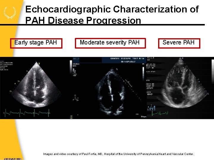 Echocardiographic Characterization of PAH Disease Progression Early stage PAH Moderate severity PAH Severe PAH