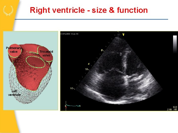 Right ventricle - size & function 