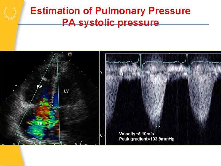 Estimation of Pulmonary Pressure PA systolic pressure Tricuspid regurgitation jet velocity 