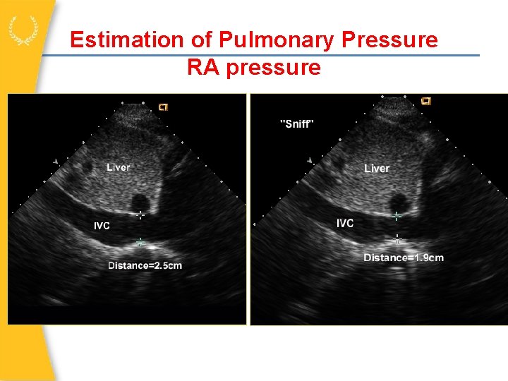 Estimation of Pulmonary Pressure RA pressure IVC size 