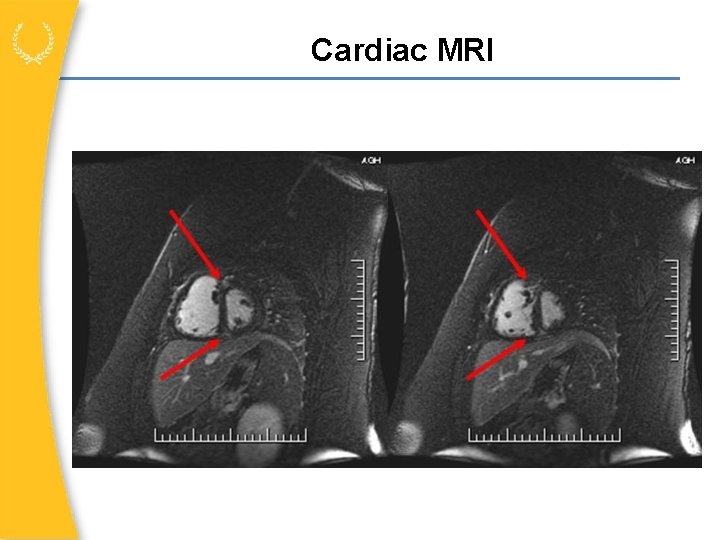 Cardiac MRI 