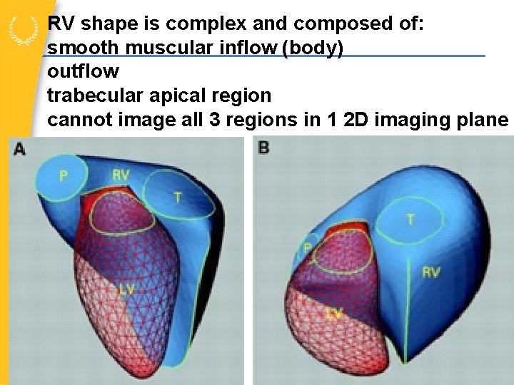 RV shape is complex and composed of: smooth muscular inflow (body) outflow trabecular apical